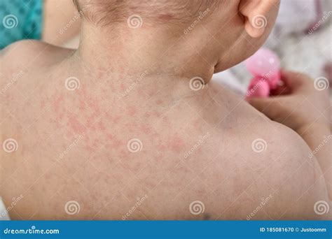 Toddler Skin Rash Roseola at Ann Copple blog