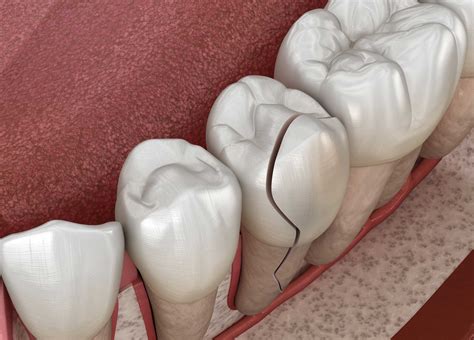 Cracked Tooth: 5 Symptoms And How To Repair Easily