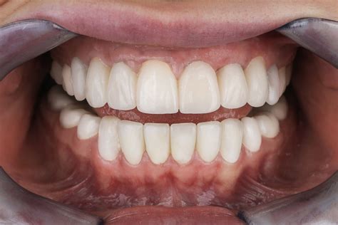 How to Reverse Gum Recession?