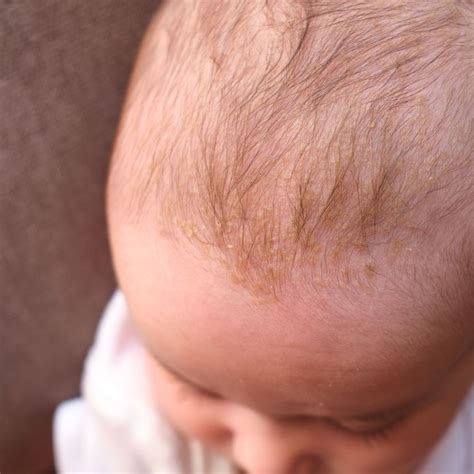 How to Treat Cradle Cap in Babies (Seborrheic Dermatitis) - What Causes Cradle Cap? - Best ...