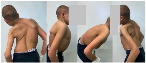 Severe Thoracic Scoliosis