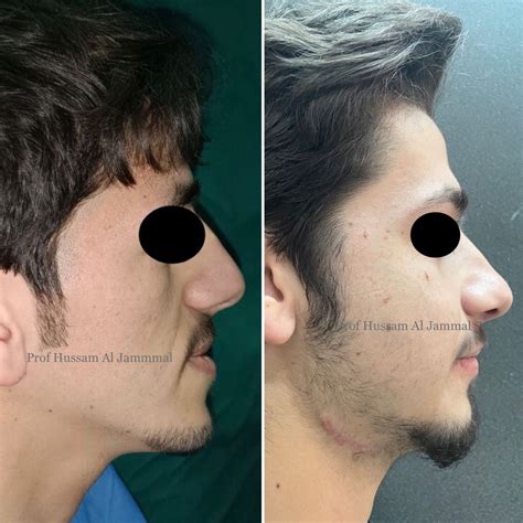 Bimax ( double jaw) -Surgery First- Orthognathic Surgery . 3d : study, stimulation, designing ...