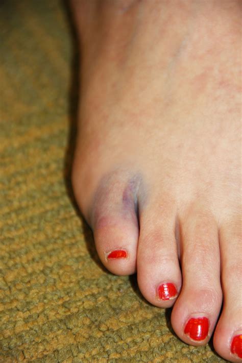 Walk with broken foot | Massapequa podiatrist | x-ray | Foot ...