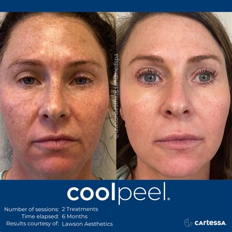CoolPeel CO2 Laser Resurfacing Treatment in Jacksonville, Florida | Hello Smooth Med Spa