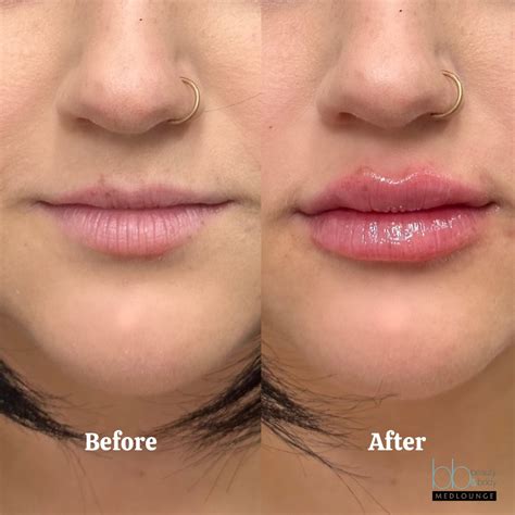 Lip Fillers San Diego, Solana Beach | Beauty and Body Medlounge