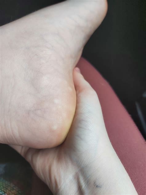 Why Do I Have White Bumps On The Bottom Of My Feet at Glen Williams blog