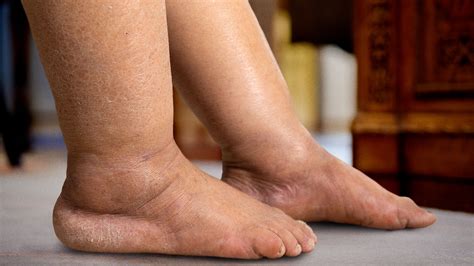 Trump Body Double Struggling To Get Leg Edema Just Right - The Onion