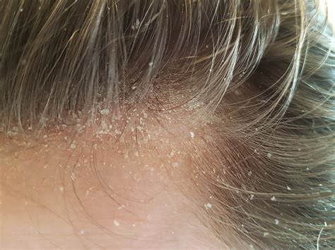 What Is Best For Eczema On Scalp at Lillie Authement blog