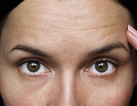 Lines & Wrinkle Treatment Edinburgh | The Stockbridge Clinic