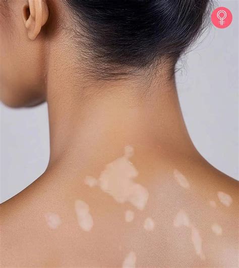 White Spots On Skin Lovetoknow White Spots On Tattoo Second Skin?