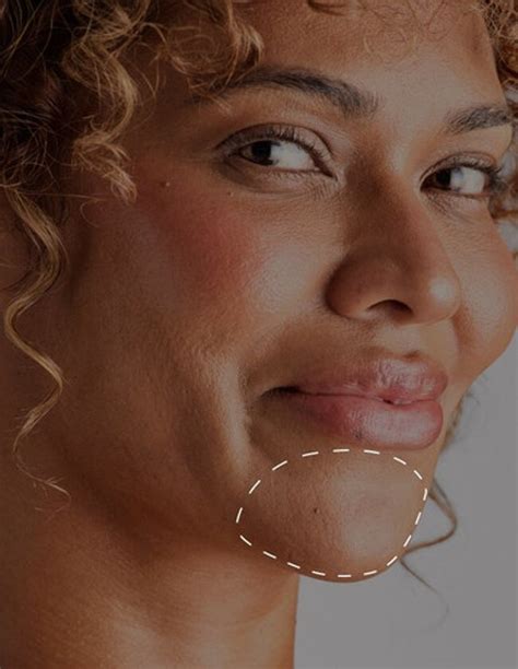 Laser Hair Removal Chin | Laser Clinics Australia