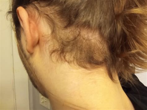 Loosing hair at nape of neck : r/Hairloss