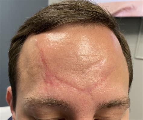 Plastic Surgery Case Study - Geometic Scar Revision of a Traumatic Forehead Degloving Scar ...