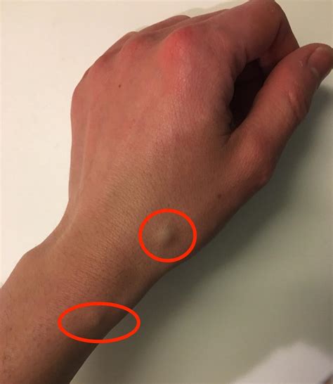 Why Is There A Lump On My Vein at Wayne Tisdale blog
