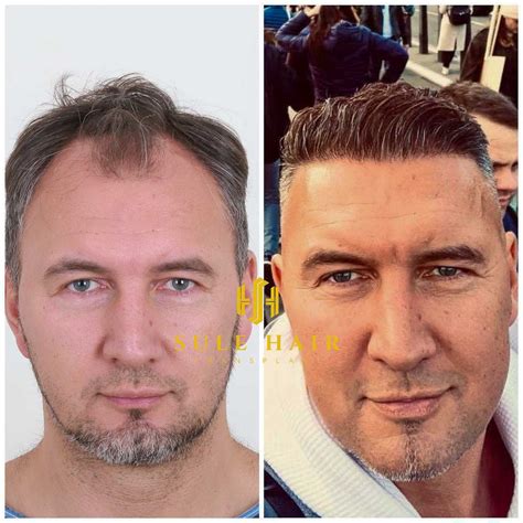 Hair Implants Cost Uk at Danielle Haynes blog