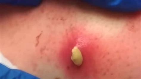 Abscess Boil | Pimple.tv | The Best Pimple Popping 2023 Videos You'll ...