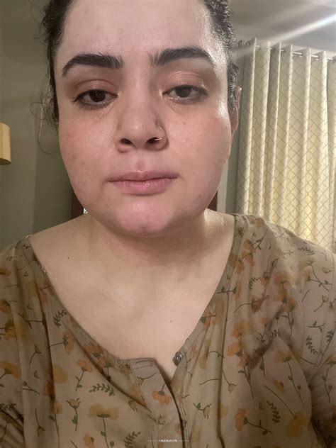 Ask a Dermatologist Online for Saggy Skin… Under Eye Bags