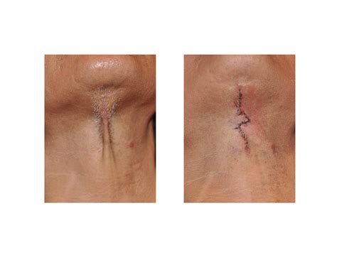 The Z-plasty Scar Revision Technique - Explore Plastic Surgery