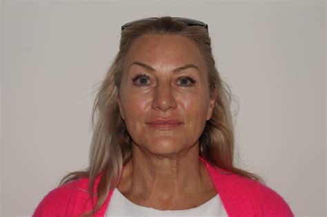 Xerf Facial Rejuvenation | Advanced Skin Renewal Treatment – Elite Med Spa