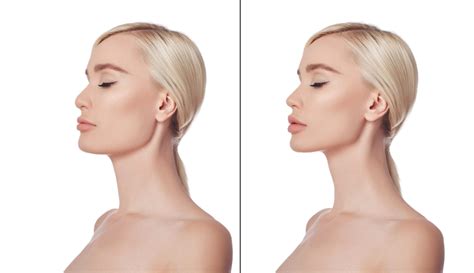 Chin Revision Genioplasty in Salt Lake City UT