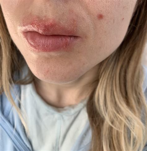 Allergic Contact Dermatitis Mouth