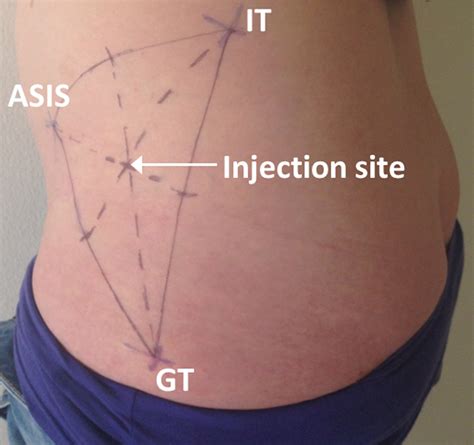 Ventrogluteal Injection Site