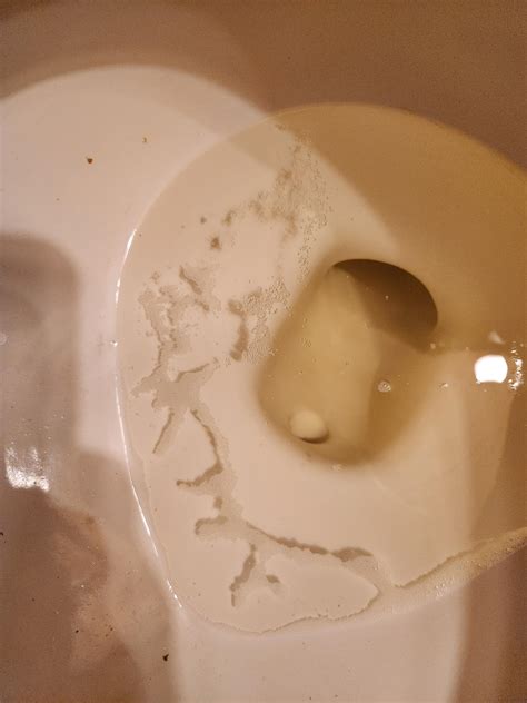 My urine looks like this : r/foamyurine