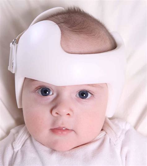 Positional Plagiocephaly Before And After