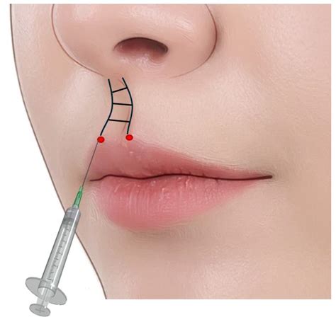 Anatomical-Based Diagnosis and Filler Injection Techniques: Lips and ...