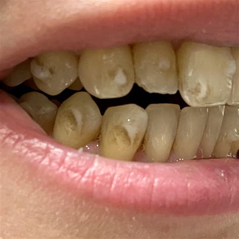 Please help whitening glue around attachments (more in comments) : r/Invisalign