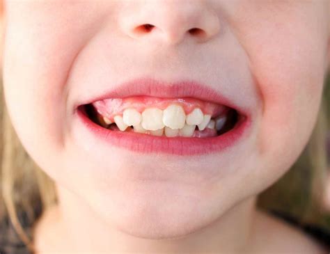 Does Braces Help Buck Teeth at Brooke Way blog