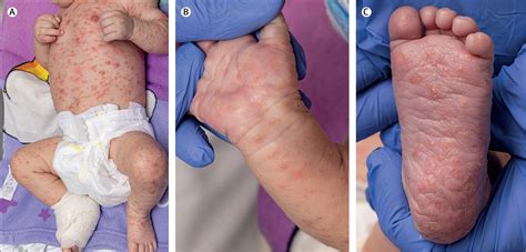 A persistent vesiculo-pustular rash, eosinophilia, and itchy parents ...