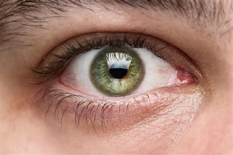 Black Spot In Eye Ball