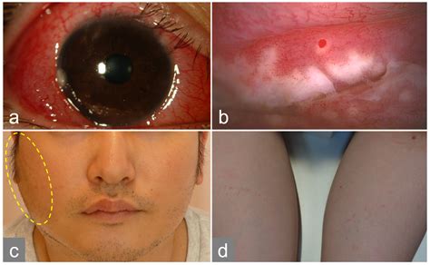 A Case of Parinaud Oculoglandular Syndrome in Which Bartonella DNA Was Detected in the Cornea ...