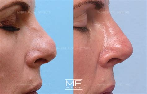 Your Top Non Surgical Nose Job Questions, Answered (Updated 2024 ...