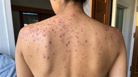 What is Lichen Planus & How Do I Find Relief at Home? – Dermeleve®