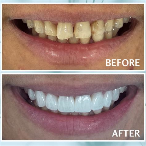 Treat Swollen Gums After Flossing | Riverview Dental Tips