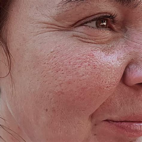 Bumpy Texture On Face