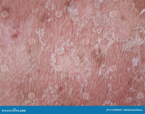 Problem Human Skin Close-up with Burn and Peeling after Sunburn Stock Photo - Image of health ...