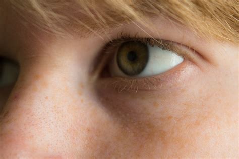 White bumps under eyes milia – Artofit