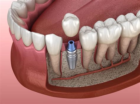 Single Tooth Implant Delhi India – MRQOI