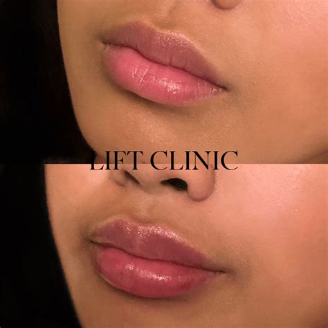 What Does 1ml of Lip Filler Look Like? 1ml Lip Fillers Before and After ...