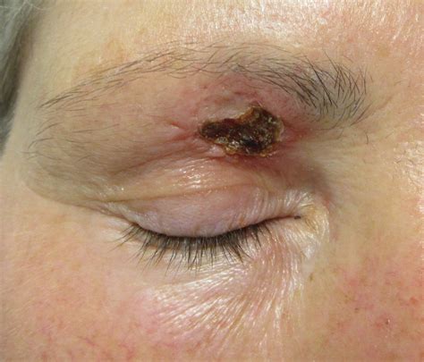 Basal Cell Carcinoma on the Eyelid | BCC Picture by Mr Tehrani