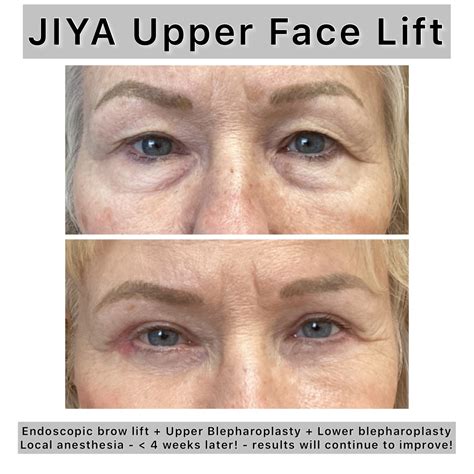 Brow Lift Surgery Raleigh, NC | Endoscopic Specialist