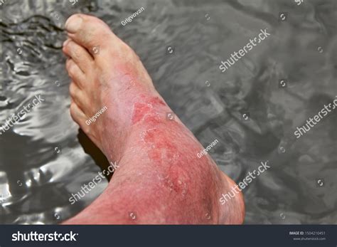 1,382 imágenes de Sunburn feet - Imágenes, fotos y vectores de stock | Shutterstock
