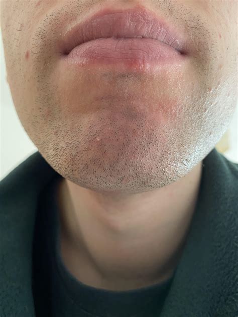 My face is calming down after the seb/perioral dermatitis flare up last night which is good ...