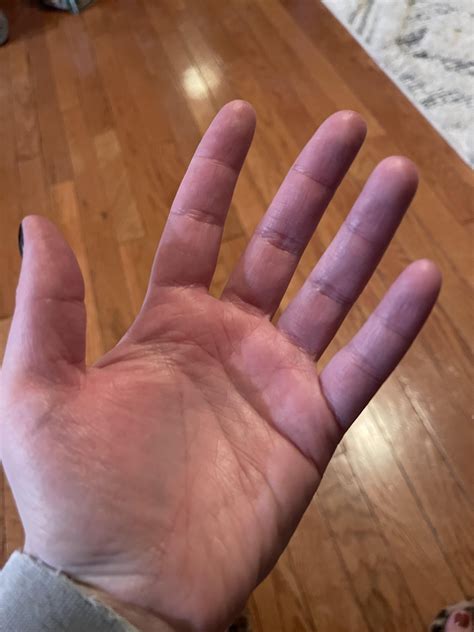 Blood pooling after manicure : r/POTS