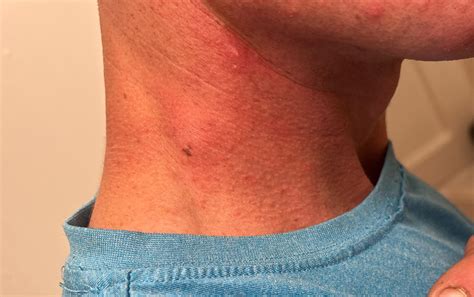 Should I be concerned? Lump on side of neck : r/medical_advice