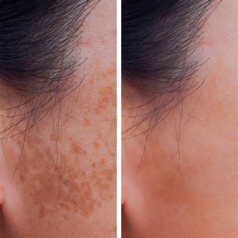 Hyperpigmentation Face Before And After