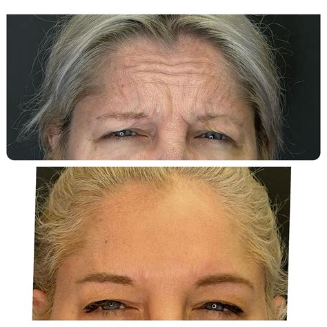 Before & After - Ascension Point Wellness